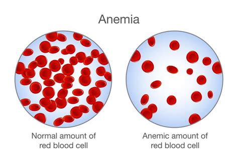 VA Rating For Anemia .